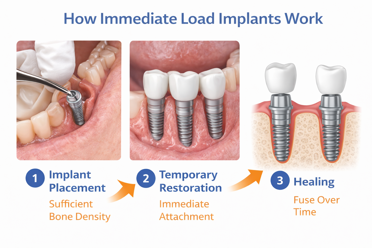 How Immediate Load Implants Work