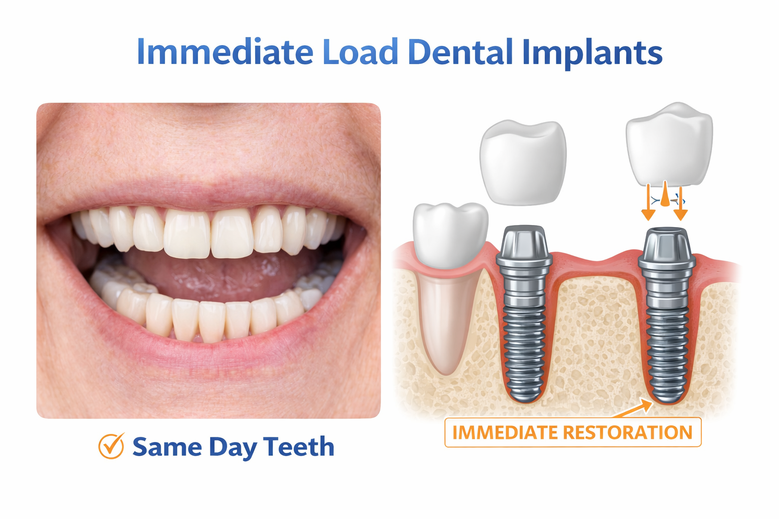 Immediate Load Dental Implants