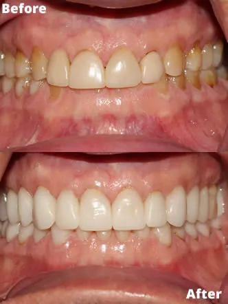 Restoring-Severe-Tooth-Wear-with-Full-Crown-Reconstruction-before-and-after-front