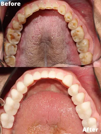 Restoring-Severe-Tooth-Wear-with-Full-Crown-Reconstruction-before-and-after-lower