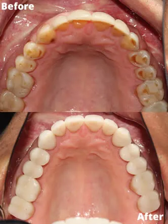 Restoring-Severe-Tooth-Wear-with-Full-Crown-Reconstruction-before-and-after-upper