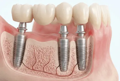 Multiple Tooth Implants