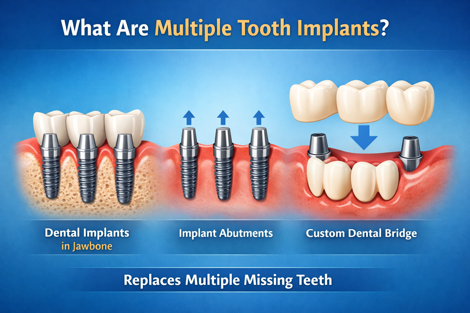 What Are Multiple Tooth Implants