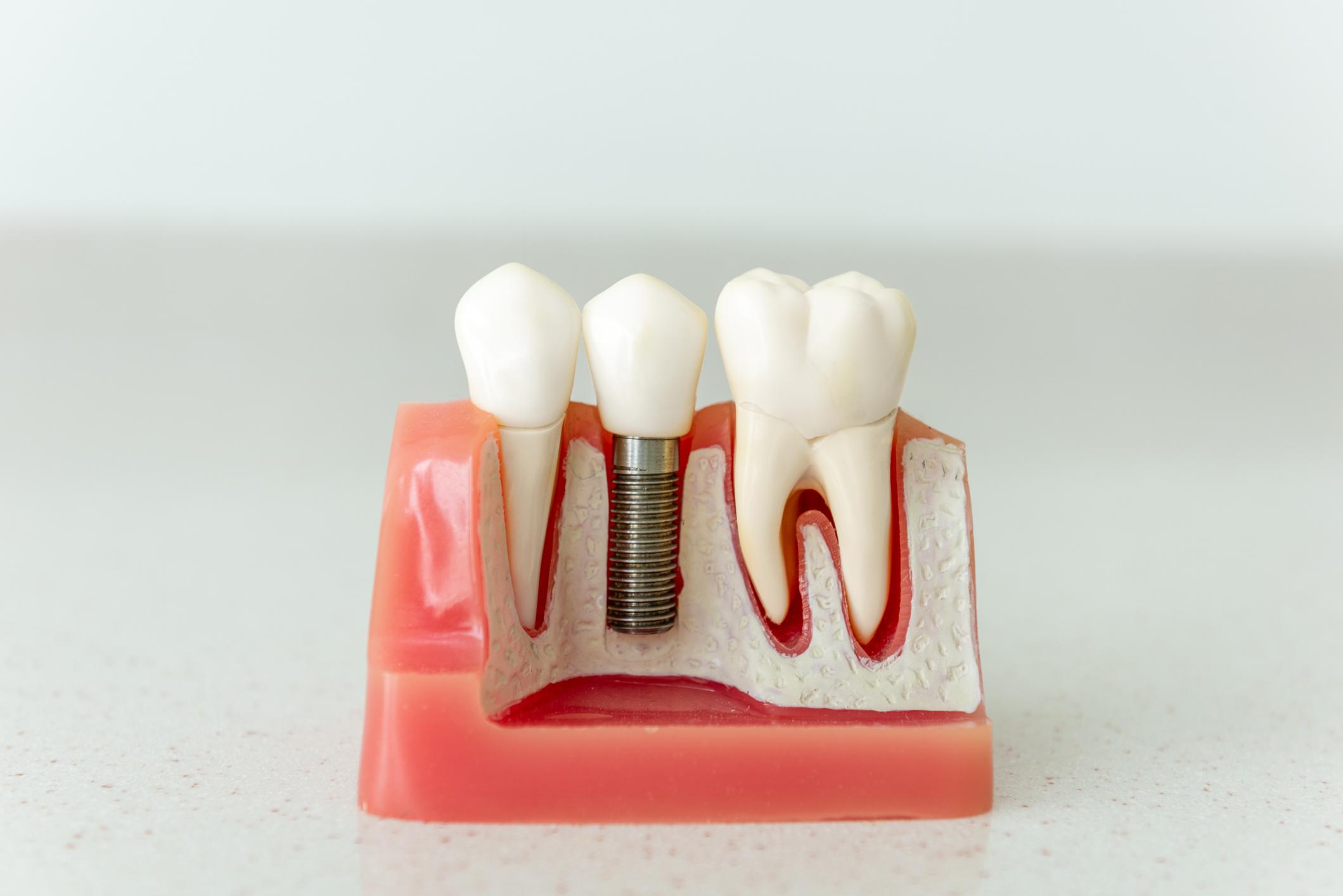 single tooth dental implant